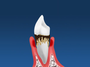 歯を失う原因のほとんどが歯周病です
