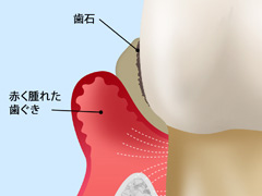 中度の歯周病