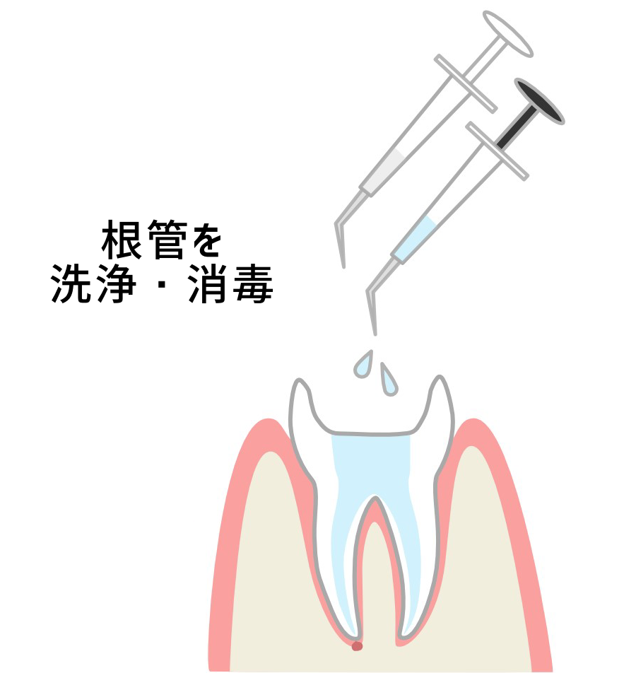 STEP2根管内部の清掃・消毒