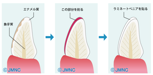 前歯の審美性を改善する「ラミネートべニア」