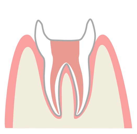 STEP4根管充填