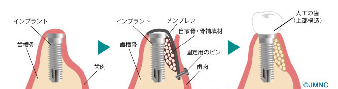 骨誘導再生法（GBR）
