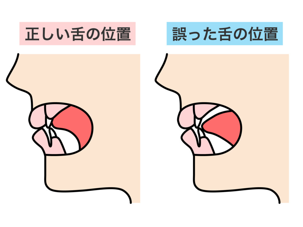 舌と唇が正しい位置になる